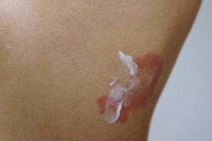 Healora Intertrigo Relief Cream Review: Can It Help Skin Fold Irritation on your skin?
