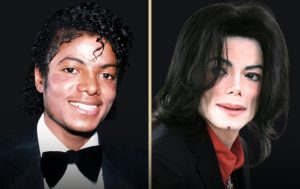 Did Michael Jackson Bleach His Skin Color or Have Vitiligo? What We Know ?